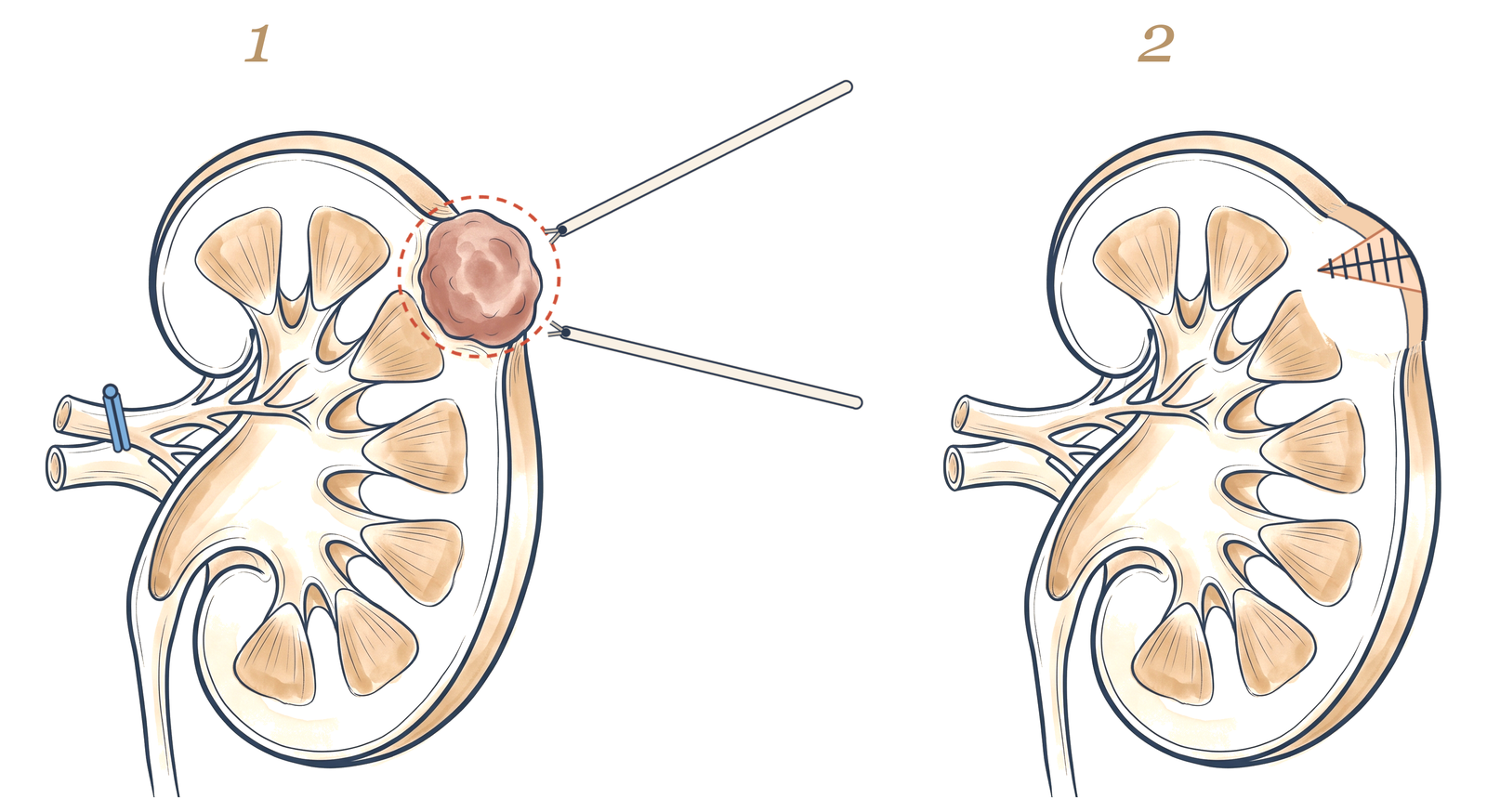 Robotic partial nephrectomy: resection margin around the tumour and a temporary clamp; the kidney sutured after tumour removal