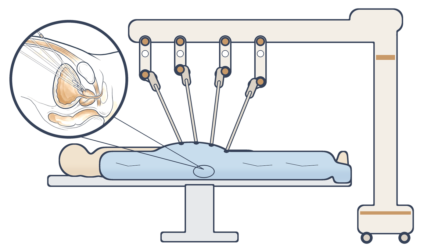 Robotic surgery: the robot beside the patient, its arms and the instruments reaching the prostate through small ports