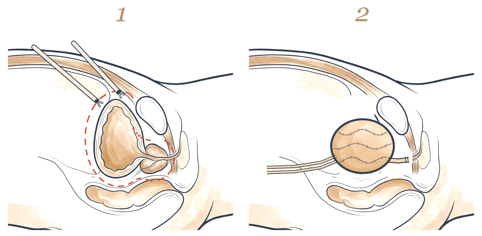 Robotic radical cystectomy: bladder and prostate to be removed; new bladder made from intestine
